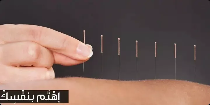 العلاج بالإبر الصينية