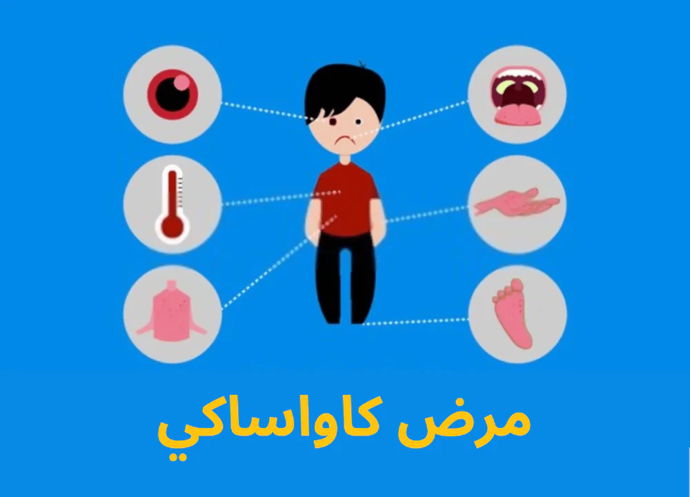 مرض كاواساكي