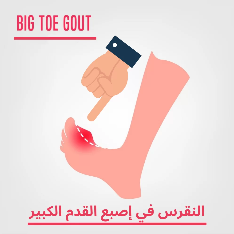 النقرس في اصبع القدم الكبير 2 1