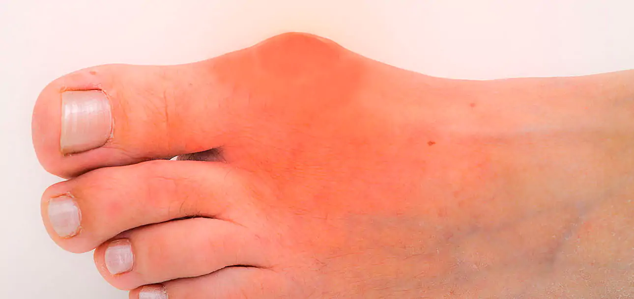 مرض النقرس : الأعراض وسبل العلاج 1 النقرس