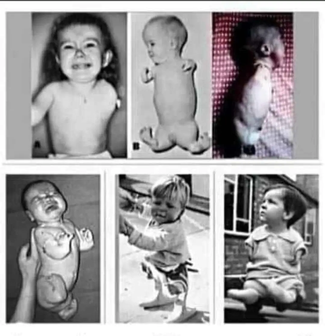 كارثة دواء الثاليدوميد : أكبر كارثة طبية في التاريخ الحديث 1 كارثة دواء الثاليدوميد